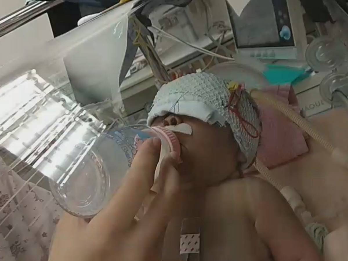女嬰患後鼻孔狹窄