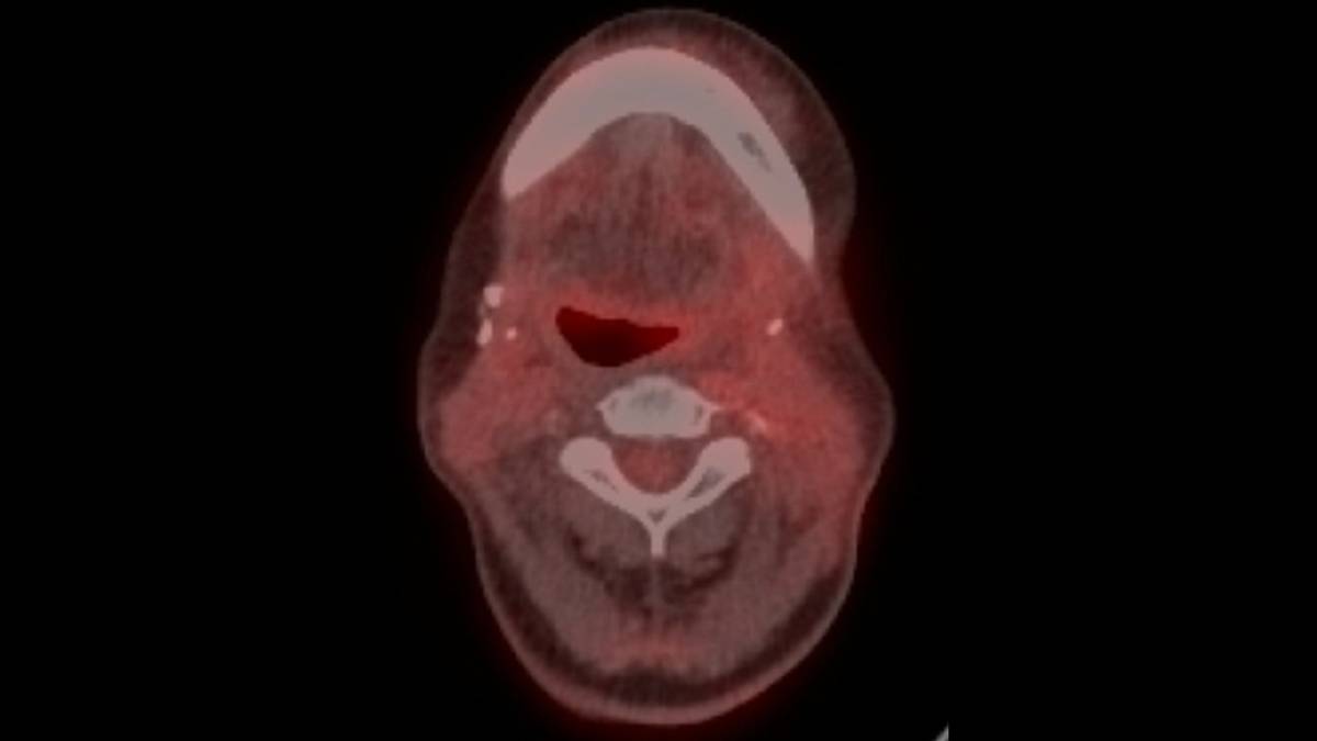 沒有標靶藥物抗藥性，後續免疫療法成效較佳。頭頸癌患者的正子攝影，可以見到沒有黃色亮部的腫瘤顯影。(陽明交大提供)